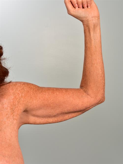 Brachioplasty (Arm Lift) Before Photo | Phoenix and Scottsdale, AZ | Scottsdale Center for Plastic Surgery