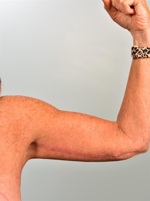 Brachioplasty (Arm Lift) After Photo | Phoenix and Scottsdale, AZ | Scottsdale Center for Plastic Surgery