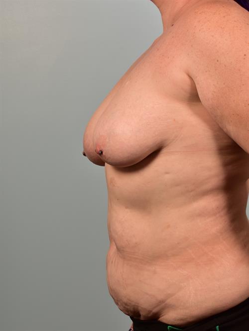 Breast Lift (Mastopexy) with Implants Before Photo | Phoenix and Scottsdale, AZ | Scottsdale Center for Plastic Surgery