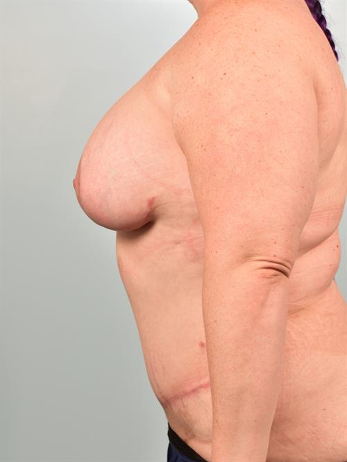 Breast Lift (Mastopexy) with Implants After Photo | Phoenix and Scottsdale, AZ | Scottsdale Center for Plastic Surgery