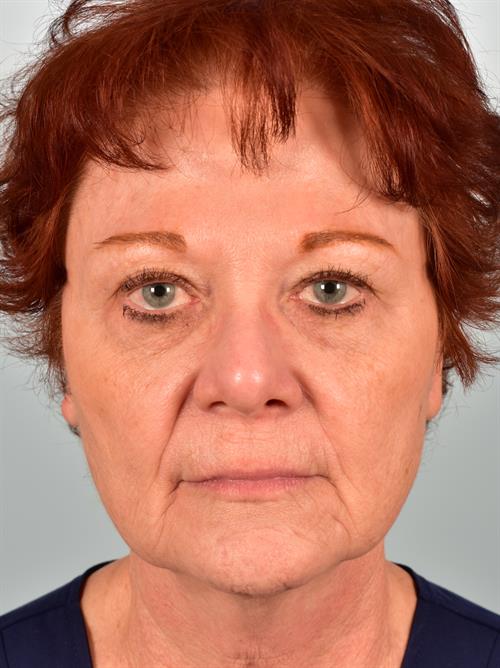 Facelift/Necklift Before Photo | Phoenix and Scottsdale, AZ | Scottsdale Center for Plastic Surgery