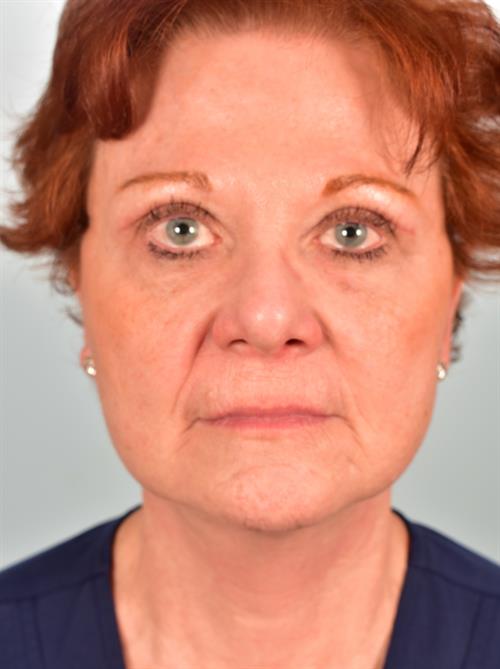 Facelift/Necklift After Photo | Phoenix and Scottsdale, AZ | Scottsdale Center for Plastic Surgery
