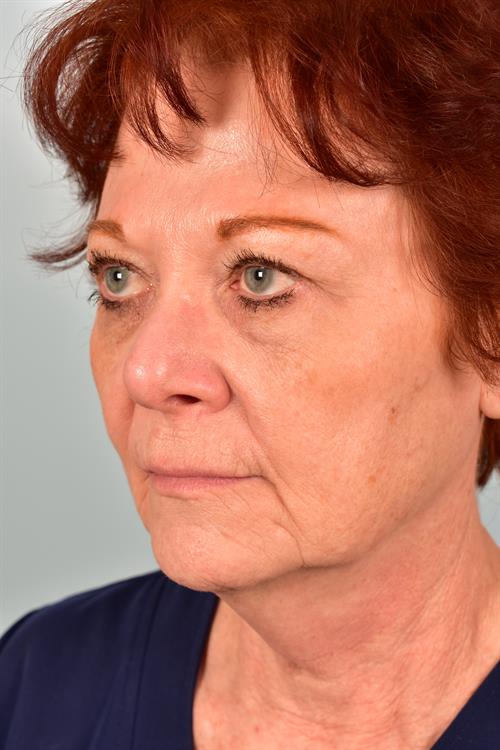 Eyelid Surgery Before Photo | Phoenix and Scottsdale, AZ | Scottsdale Center for Plastic Surgery