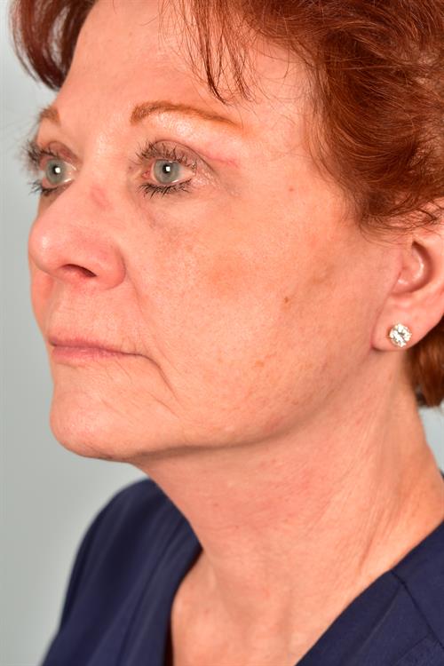 Eyelid Surgery After Photo | Phoenix and Scottsdale, AZ | Scottsdale Center for Plastic Surgery