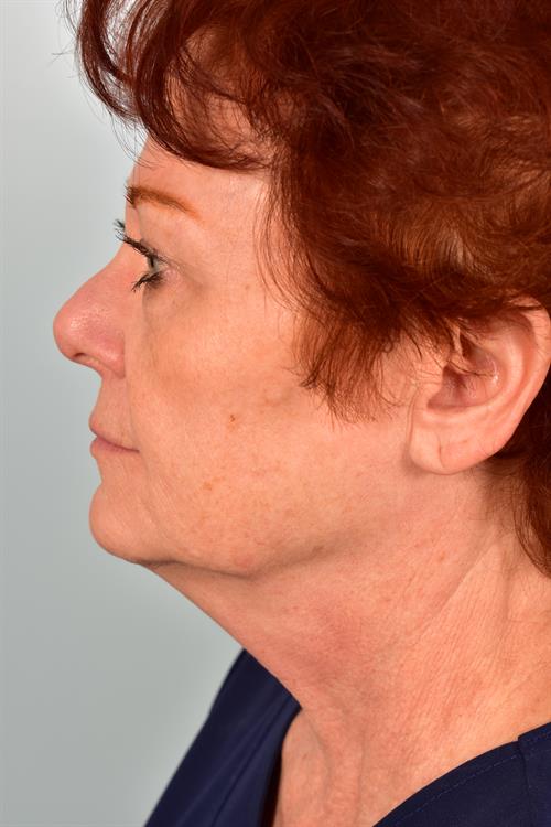 Eyelid Surgery Before Photo | Phoenix and Scottsdale, AZ | Scottsdale Center for Plastic Surgery