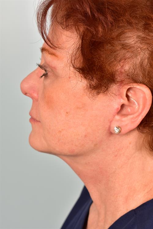Eyelid Surgery After Photo | Phoenix and Scottsdale, AZ | Scottsdale Center for Plastic Surgery