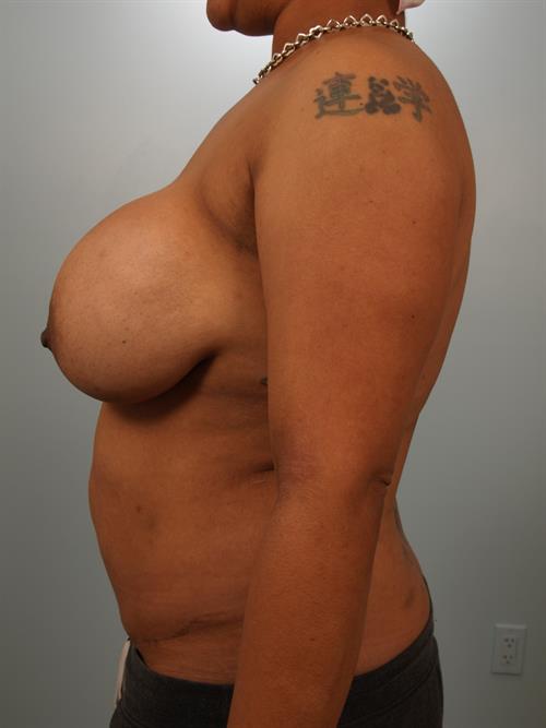 Breast Implant Removal Before Photo | Phoenix and Scottsdale, AZ | Scottsdale Center for Plastic Surgery