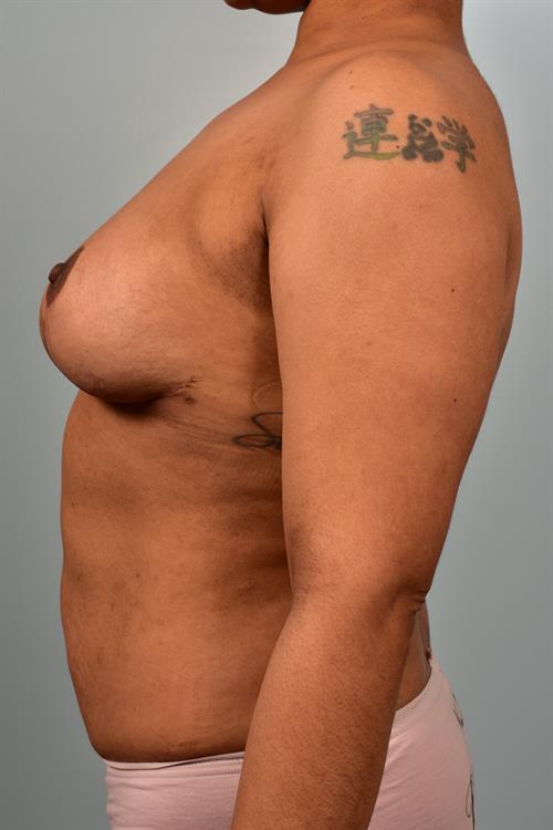 Breast Implant Removal After Photo | Phoenix and Scottsdale, AZ | Scottsdale Center for Plastic Surgery