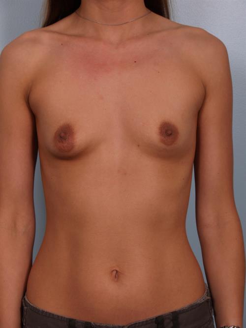 Breast Augmentation Before Photo | Phoenix and Scottsdale, AZ | Scottsdale Center for Plastic Surgery