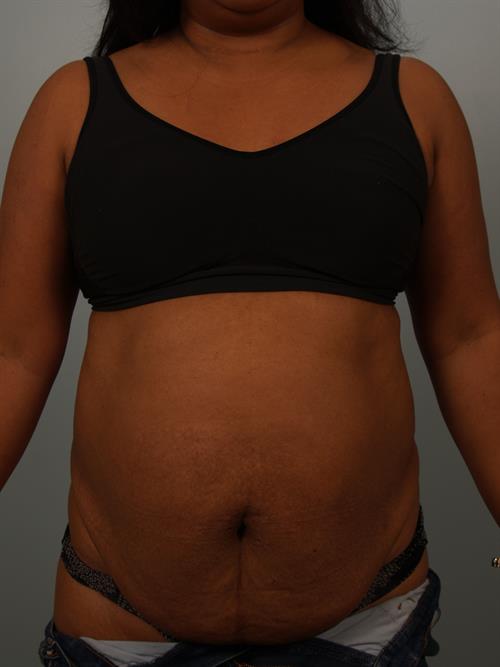 Tummy Tuck Before Photo | Phoenix and Scottsdale, AZ | Scottsdale Center for Plastic Surgery