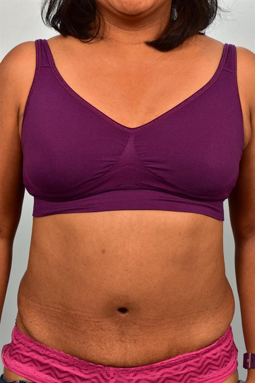 Tummy Tuck After Photo | Phoenix and Scottsdale, AZ | Scottsdale Center for Plastic Surgery