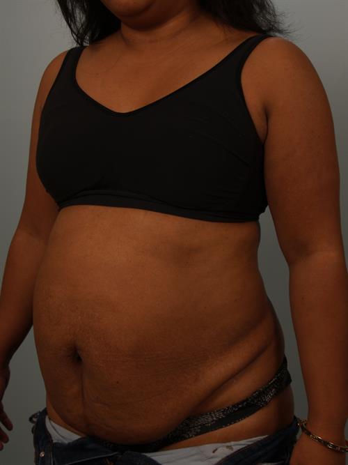 Tummy Tuck Before Photo | Phoenix and Scottsdale, AZ | Scottsdale Center for Plastic Surgery
