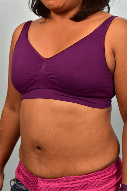 Tummy Tuck After Photo | Phoenix and Scottsdale, AZ | Scottsdale Center for Plastic Surgery