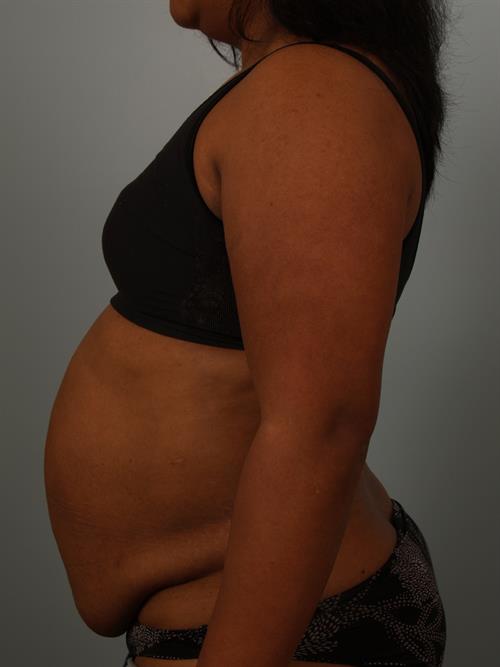 Tummy Tuck Before Photo | Phoenix and Scottsdale, AZ | Scottsdale Center for Plastic Surgery