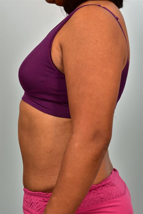 Tummy Tuck After Photo | Phoenix and Scottsdale, AZ | Scottsdale Center for Plastic Surgery
