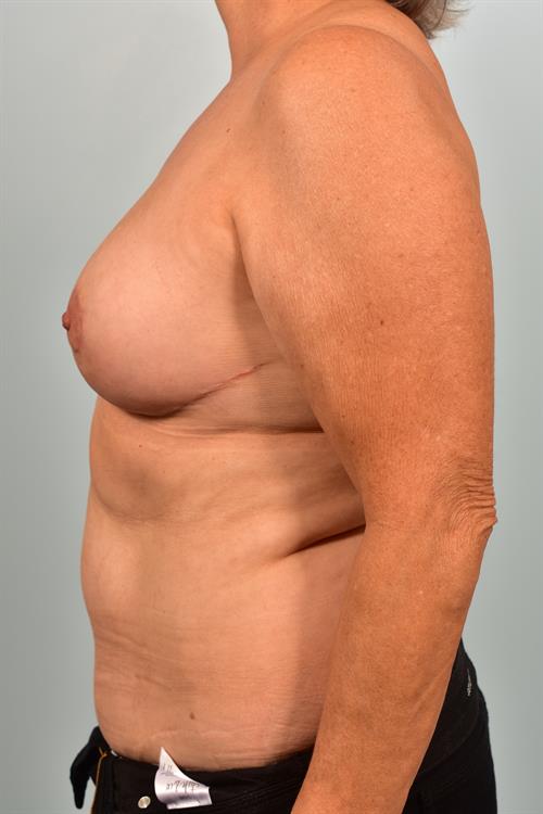 Breast Implant Removal After Photo | Phoenix and Scottsdale, AZ | Scottsdale Center for Plastic Surgery
