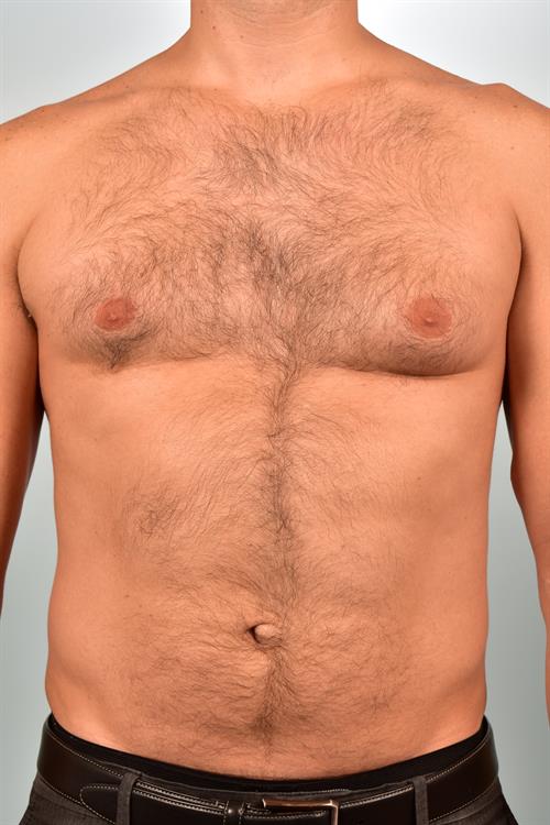 Male Breast/Areola Reduction Before Photo | Phoenix and Scottsdale, AZ | Scottsdale Center for Plastic Surgery