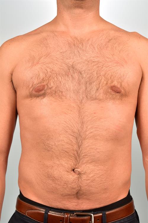 Male Breast/Areola Reduction After Photo | Phoenix and Scottsdale, AZ | Scottsdale Center for Plastic Surgery