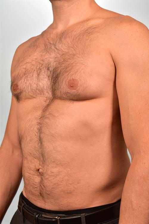 Male Breast/Areola Reduction Before Photo | Phoenix and Scottsdale, AZ | Scottsdale Center for Plastic Surgery