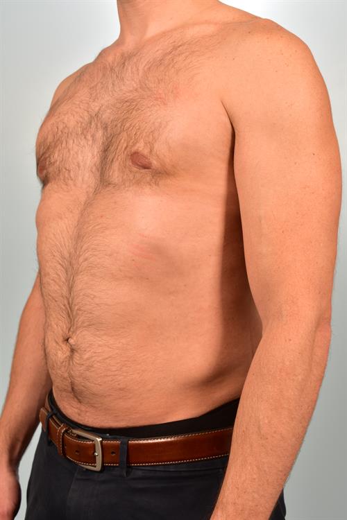 Male Breast/Areola Reduction After Photo | Phoenix and Scottsdale, AZ | Scottsdale Center for Plastic Surgery