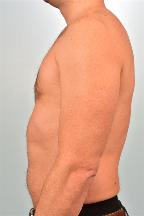 Male Breast/Areola Reduction After Photo | Phoenix and Scottsdale, AZ | Scottsdale Center for Plastic Surgery