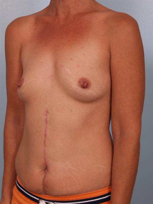 Breast Augmentation Before Photo | Phoenix and Scottsdale, AZ | Scottsdale Center for Plastic Surgery