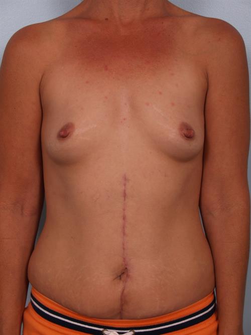 Breast Augmentation Before Photo | Phoenix and Scottsdale, AZ | Scottsdale Center for Plastic Surgery