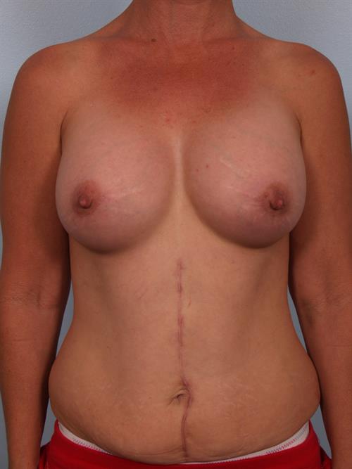 Breast Augmentation After Photo | Phoenix and Scottsdale, AZ | Scottsdale Center for Plastic Surgery