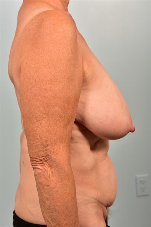 Mommy Makeover Before Photo | Phoenix and Scottsdale, AZ | Scottsdale Center for Plastic Surgery