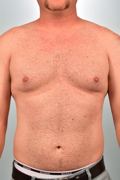 Male Breast/Areola Reduction Before Photo | Phoenix and Scottsdale, AZ | Scottsdale Center for Plastic Surgery