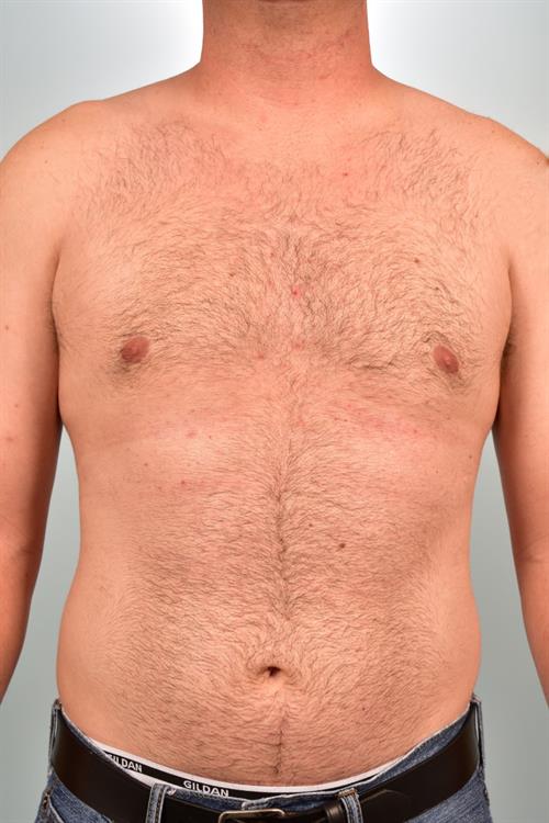 Male Breast/Areola Reduction After Photo | Phoenix and Scottsdale, AZ | Scottsdale Center for Plastic Surgery