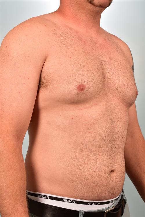 Male Breast/Areola Reduction Before Photo | Phoenix and Scottsdale, AZ | Scottsdale Center for Plastic Surgery