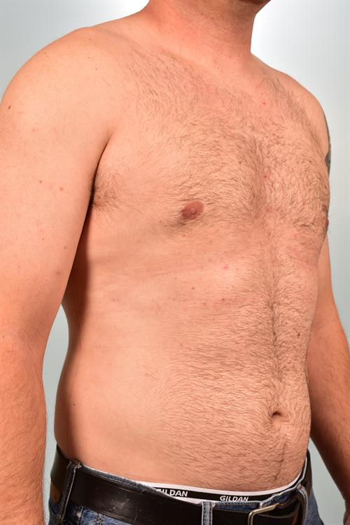 Male Breast/Areola Reduction After Photo | Phoenix and Scottsdale, AZ | Scottsdale Center for Plastic Surgery