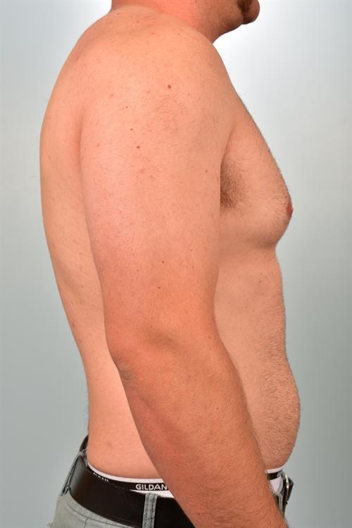 Male Breast/Areola Reduction Before Photo | Phoenix and Scottsdale, AZ | Scottsdale Center for Plastic Surgery