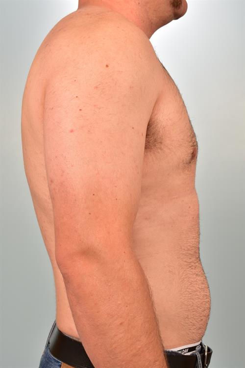 Male Breast/Areola Reduction After Photo | Phoenix and Scottsdale, AZ | Scottsdale Center for Plastic Surgery