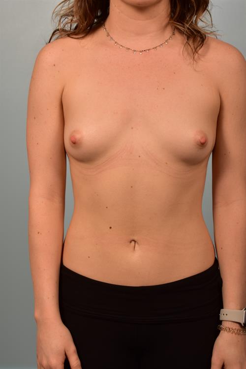 Breast Augmentation Before Photo | Phoenix and Scottsdale, AZ | Scottsdale Center for Plastic Surgery