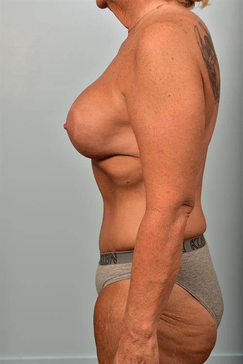 Mommy Makeover After Photo | Phoenix and Scottsdale, AZ | Scottsdale Center for Plastic Surgery