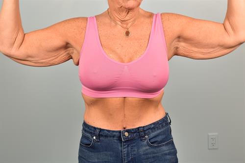 Mommy Makeover Before Photo | Phoenix and Scottsdale, AZ | Scottsdale Center for Plastic Surgery