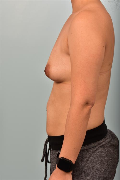 Sub-Fascial Breast Augmentation Before Photo | Phoenix and Scottsdale, AZ | Scottsdale Center for Plastic Surgery