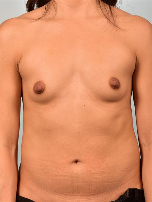 Breast Augmentation Before Photo | Phoenix and Scottsdale, AZ | Scottsdale Center for Plastic Surgery