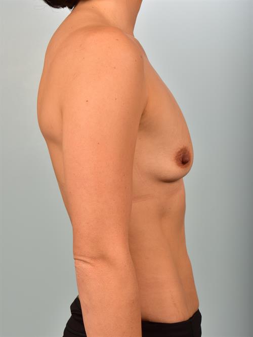 Breast Augmentation Before Photo | Phoenix and Scottsdale, AZ | Scottsdale Center for Plastic Surgery