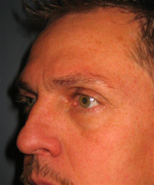 Restylane Before Photo | Phoenix and Scottsdale, AZ | Scottsdale Center for Plastic Surgery
