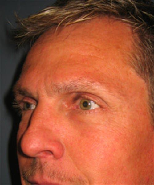 Restylane After Photo | Phoenix and Scottsdale, AZ | Scottsdale Center for Plastic Surgery