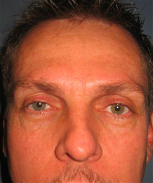 Restylane Before Photo | Phoenix and Scottsdale, AZ | Scottsdale Center for Plastic Surgery