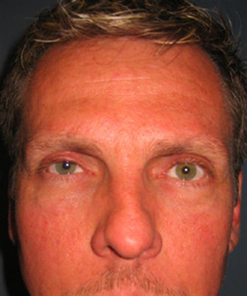 Restylane After Photo | Phoenix and Scottsdale, AZ | Scottsdale Center for Plastic Surgery