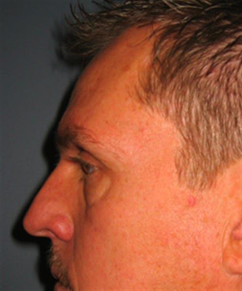 Restylane Before Photo | Phoenix and Scottsdale, AZ | Scottsdale Center for Plastic Surgery