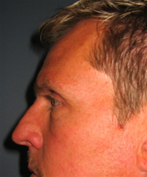 Restylane After Photo | Phoenix and Scottsdale, AZ | Scottsdale Center for Plastic Surgery