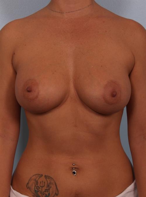 Breast Augmentation After Photo | Phoenix and Scottsdale, AZ | Scottsdale Center for Plastic Surgery