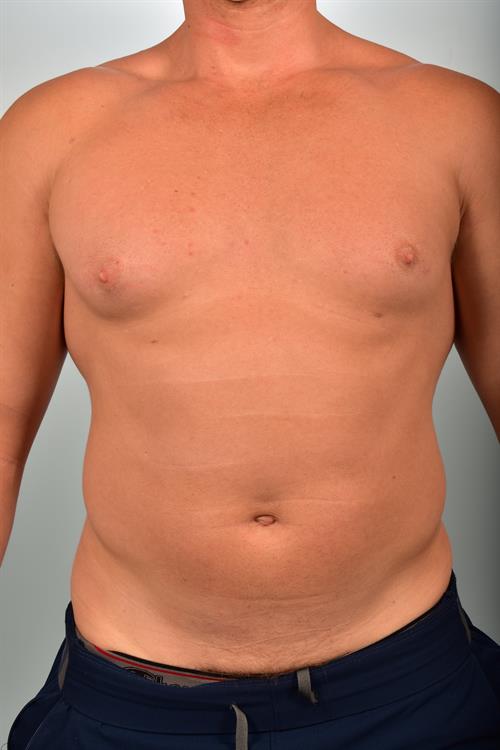 Male Liposuction Before Photo | Phoenix and Scottsdale, AZ | Scottsdale Center for Plastic Surgery