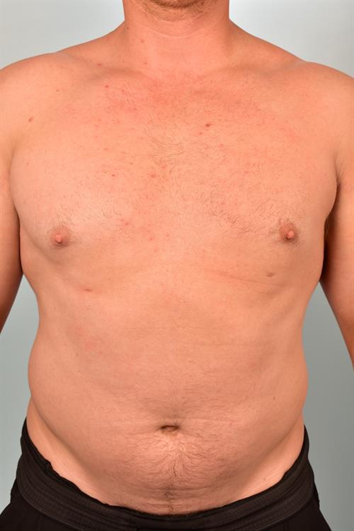 Male Liposuction After Photo | Phoenix and Scottsdale, AZ | Scottsdale Center for Plastic Surgery